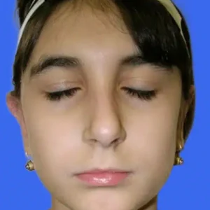 Ear Surgery before and after photos