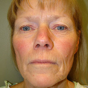 Face Lift before and after photos