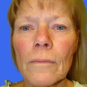 Face Lift before and after photos