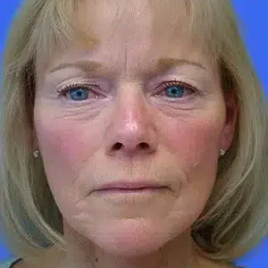 Face Lift before and after photos