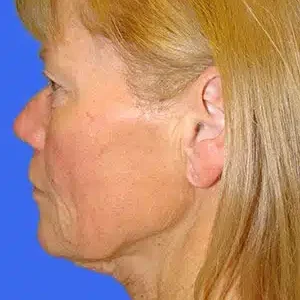 Face Lift before and after photos