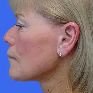 Face Lift before and after photos