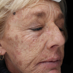 Laser Skin Resurfacing before and after photos