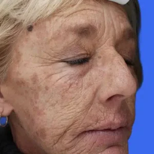 Laser Skin Resurfacing before and after photos
