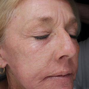 Laser Skin Resurfacing before and after photos