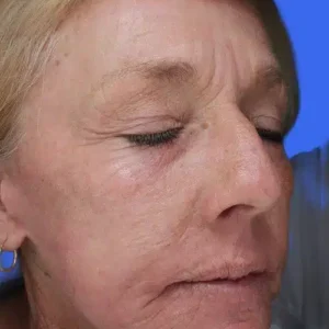 Laser Skin Resurfacing before and after photos