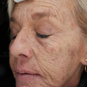 Laser Skin Resurfacing before and after photos