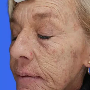 Laser Skin Resurfacing before and after photos