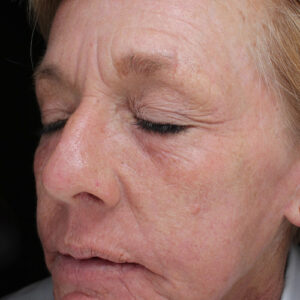 Laser Skin Resurfacing before and after photos