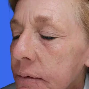 Laser Skin Resurfacing before and after photos