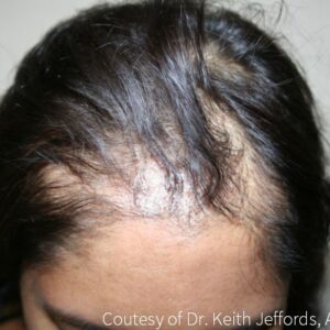 Neograft Hair Loss Replacement before and after photos