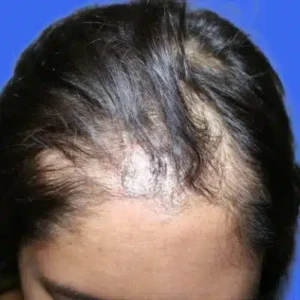 Neograft Hair Loss Replacement before and after photos