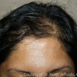 Neograft Hair Loss Replacement before and after photos