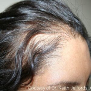 Neograft Hair Loss Replacement before and after photos