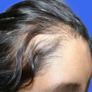 Neograft Hair Loss Replacement before and after photos