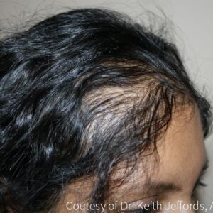 Neograft Hair Loss Replacement before and after photos