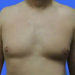 Male Breast Reduction before and after photos