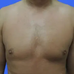 Male Breast Reduction before and after photos