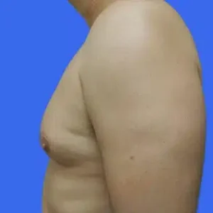 Male Breast Reduction before and after photos