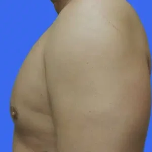 Male Breast Reduction before and after photos