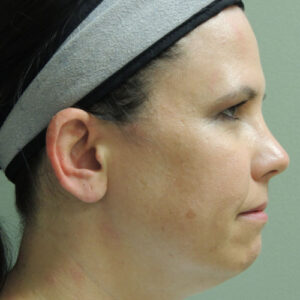 Laser Lift before and after photos