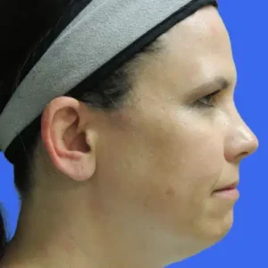 Laser Lift before and after photos