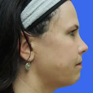 Laser Lift before and after photos