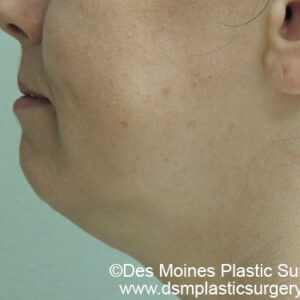 Laser Lift before and after photos