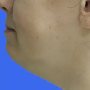 Laser Lift before and after photos