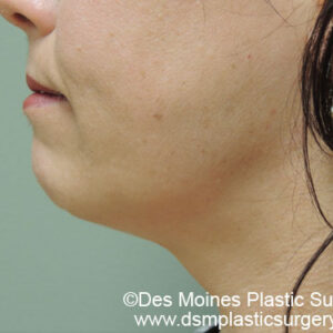 Laser Lift before and after photos