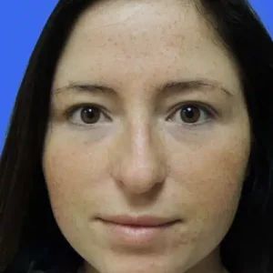 Rhinoplasty before and after photos