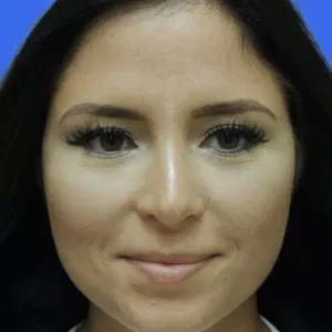 Rhinoplasty before and after photos