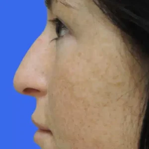 Rhinoplasty before and after photos