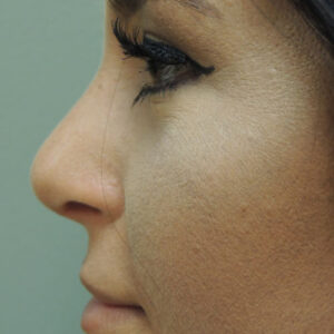 Rhinoplasty before and after photos