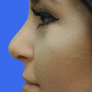 Rhinoplasty before and after photos