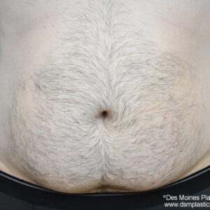 Liposuction before and after photos
