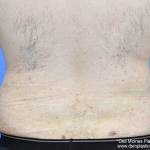 Liposuction before and after photos