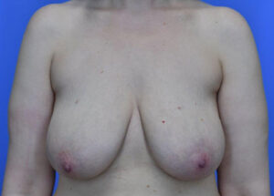 Breast Lift before and after photos