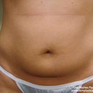 Liposuction before and after photos