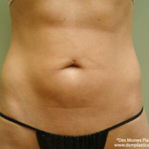 Liposuction before and after photos