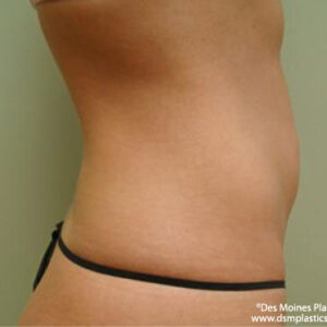 Liposuction before and after photos