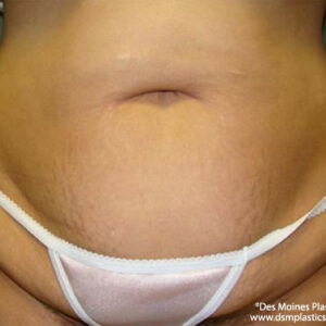 Tummy Tuck before and after photos