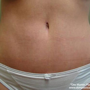 Tummy Tuck before and after photos