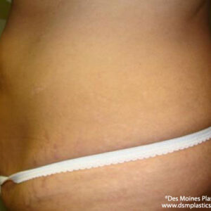 Tummy Tuck before and after photos