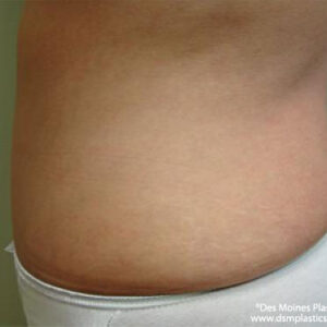 Tummy Tuck before and after photos