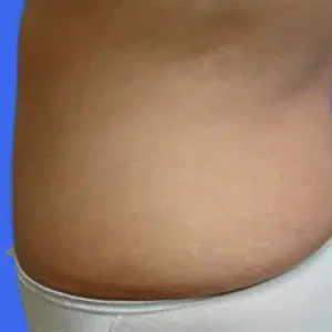Tummy Tuck before and after photos Tummy Tuck before and after photos