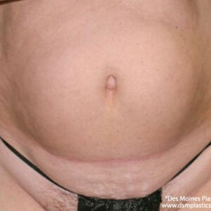 Liposuction before and after photos