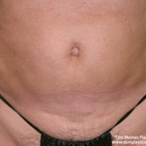 Liposuction before and after photos