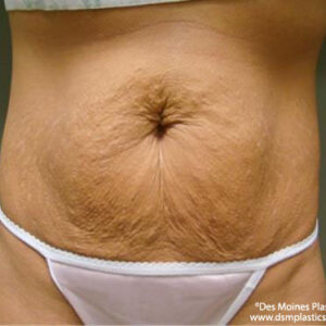 Tummy Tuck before and after photos
