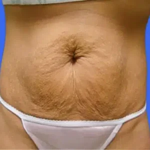 Tummy Tuck before and after photos Tummy Tuck before and after photos